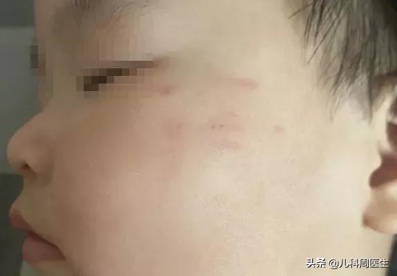 被小猫挠伤需要打疫苗吗,被猫挠了出血了需要打疫苗吗