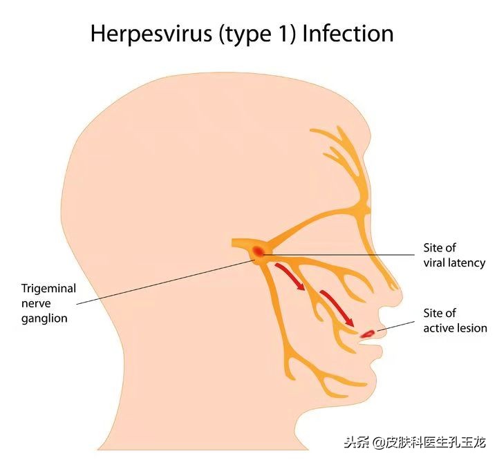 嘴唇长疱疹是哪里上火了,嘴唇上火起泡和单纯疱疹怎么区别