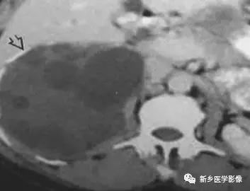 腹部平片可以看出肠胃疾病吗,腹部散在结节状高密度影