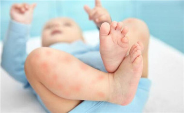 宝宝长湿疹后皮肤受损怎么护理,婴儿面部湿疹怎么护理效果最好