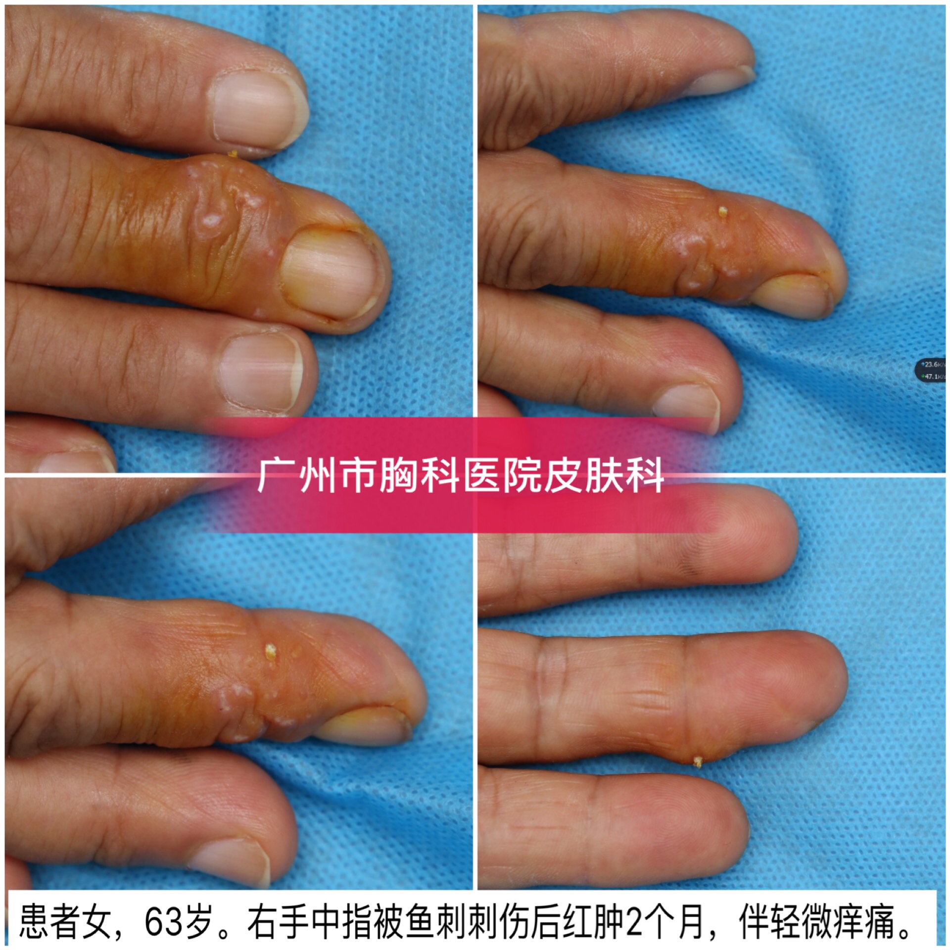 鱼刺扎手了找不到鱼刺怎么办,鱼刺扎手肿了的毒素叫什么