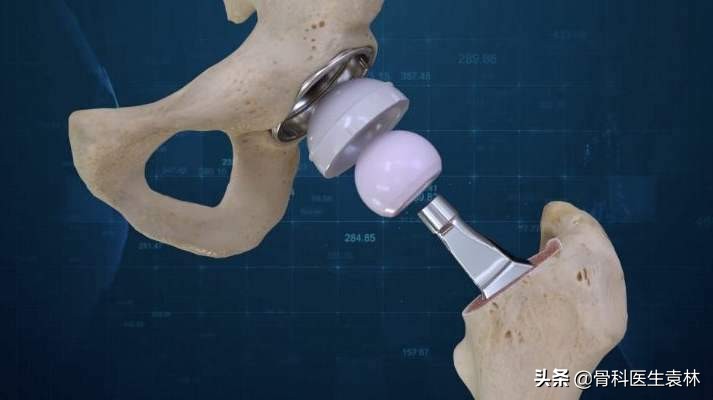 股骨头坏死的治疗方法,早期股骨头坏死如何治疗可以治愈