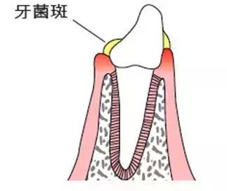 一口黄牙影响颜值,一口黄牙齿