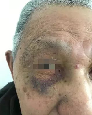 娶了小35岁保姆后，退休老师被殴打多处骨折，有家难回