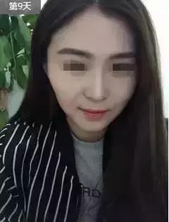 瘦脸针的5个常见问题,瘦脸针其实副作用挺大的