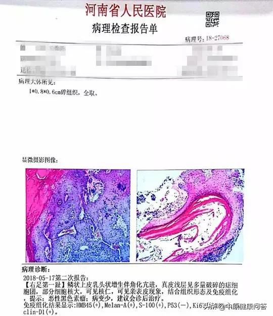 66岁女子为了治疗灰指甲把大脚拇指甲拔掉