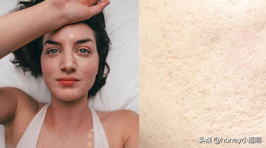 收缩毛孔改善毛孔粗大精华液,毛孔粗大有什么好修复