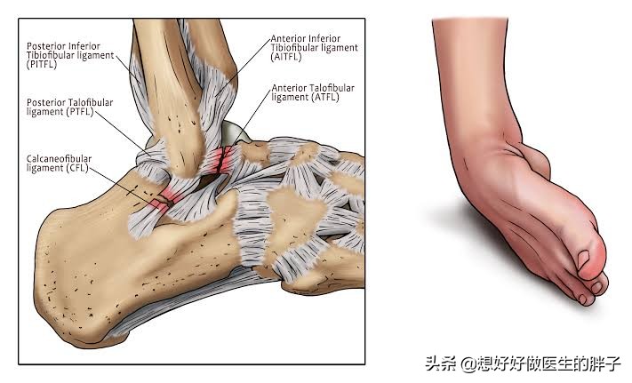 脚踝扭伤胫骨腓骨远端有点疼,腓骨受伤恢复
