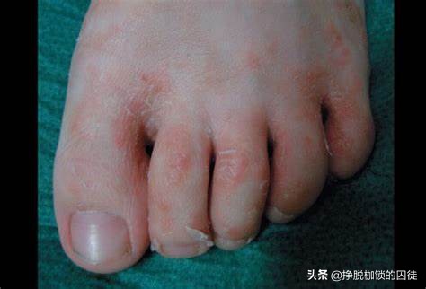 每年初夏手都会脱皮是怎么回事,手每年春天手掌脱皮是什么原因