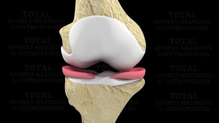 膝关节镜手术后一周怎样康复训练,膝关节镜手术后要怎样锻炼