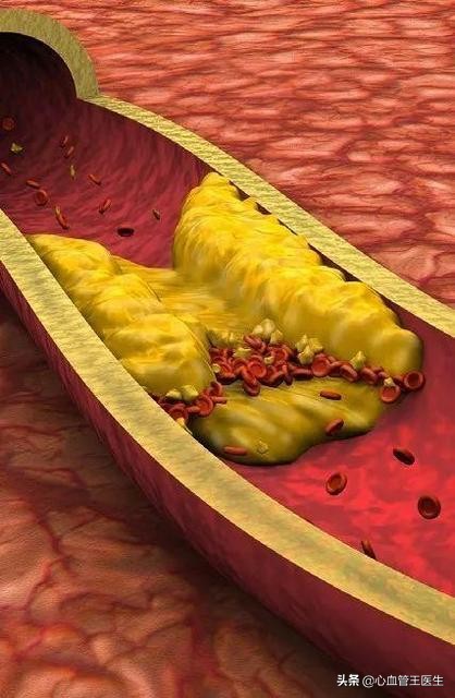 心脏血管狭窄50%还需做造影吗,心脏血管狭窄50%怎么办