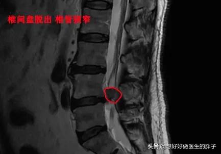 腰椎间盘突出核掉椎管里怎么治疗,腰椎间盘髓核掉进椎管严重吗