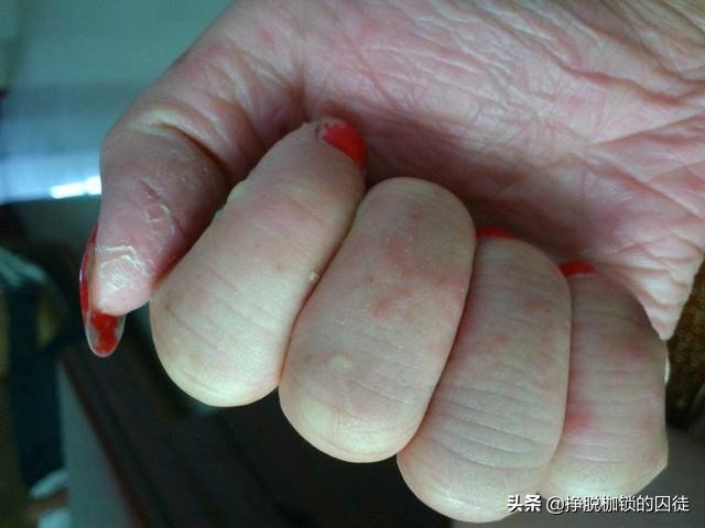 手每年春天手掌脱皮是什么原因,每年初夏手就开始脱皮