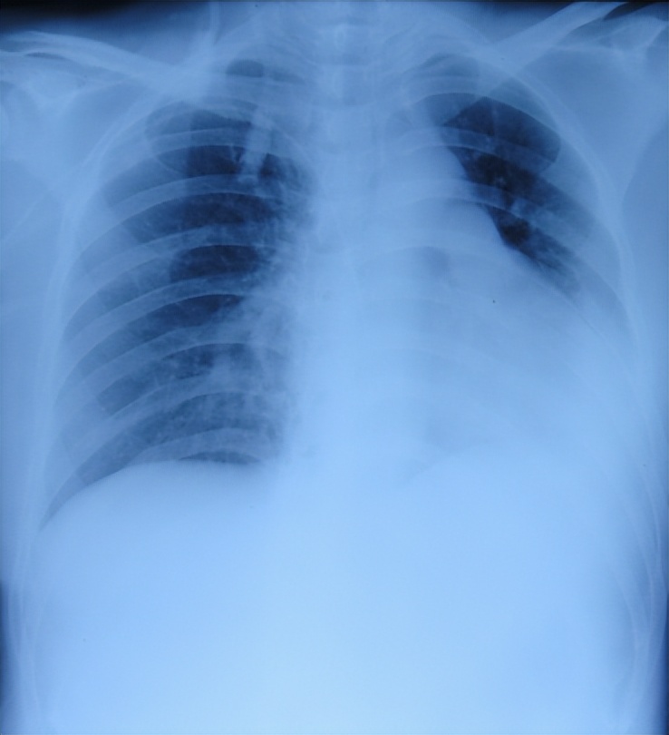 听神经瘤出现脑积水和出血,听神经瘤手术后颅压高症状