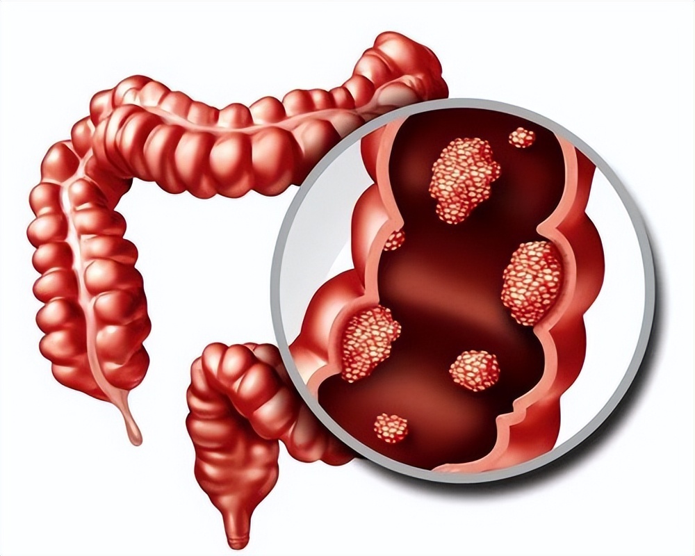 胆囊切除后遗症有哪些,胆囊切除都有哪些后遗症