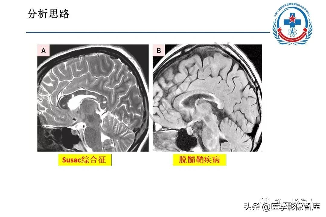 胼胝体变性治疗方法,原发性胼胝体病变治疗