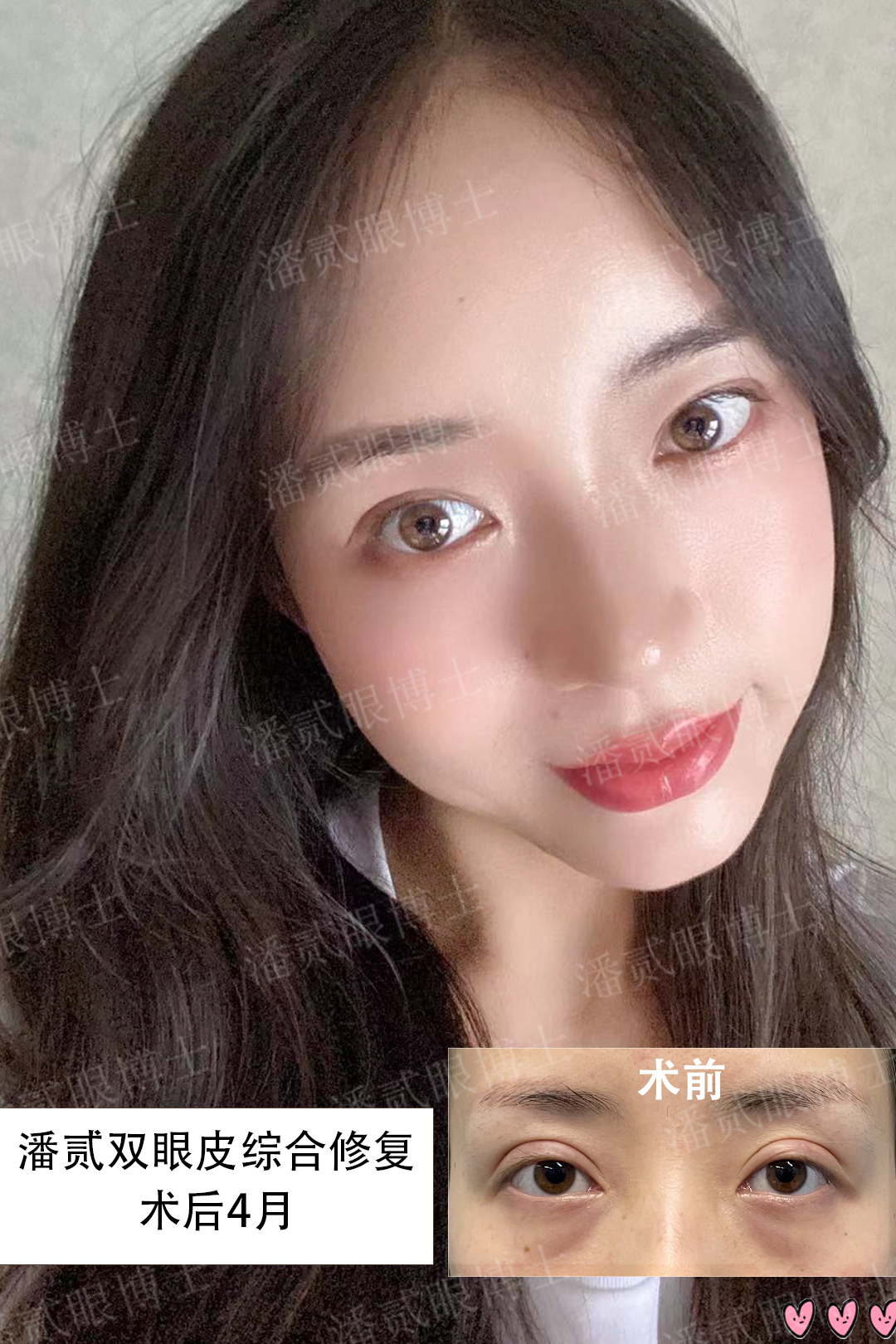 割双眼皮失败女的视频最新,割双眼皮失败女网红