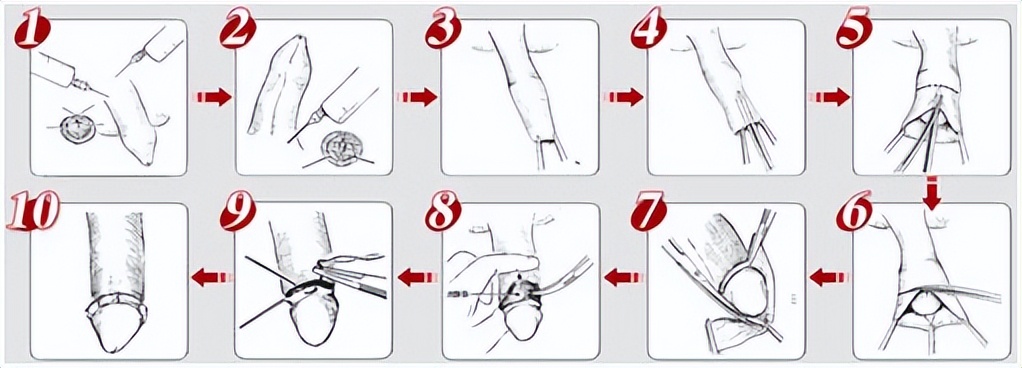 割包皮早割迟有影响吗,早割包皮对孩子的好处