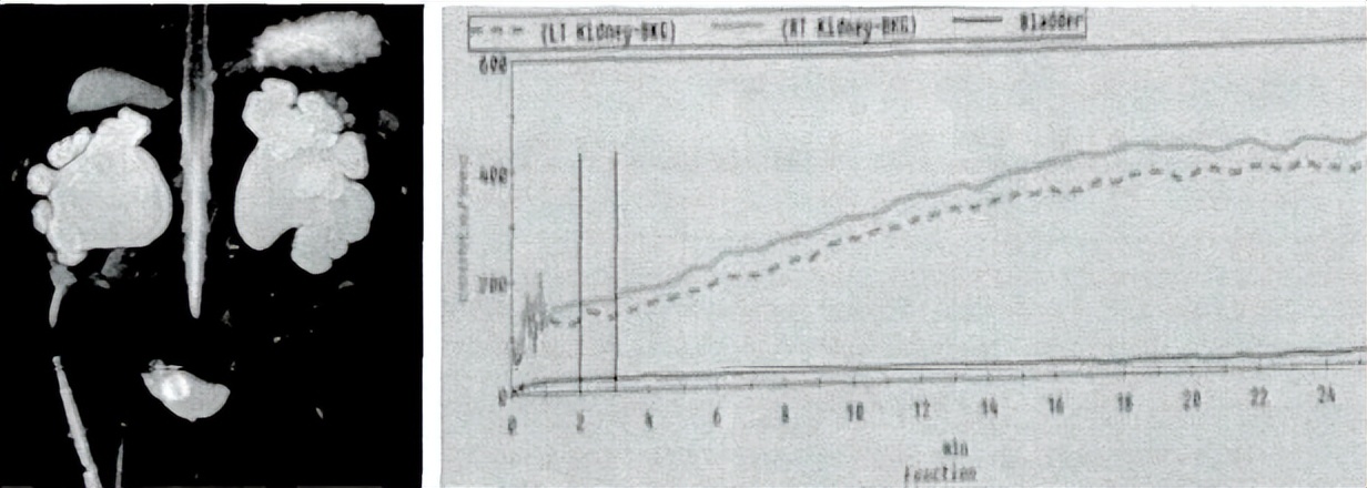 中医治疗宝宝肾积水输尿管狭窄,小儿肾积水和输尿管扩张怎么治疗