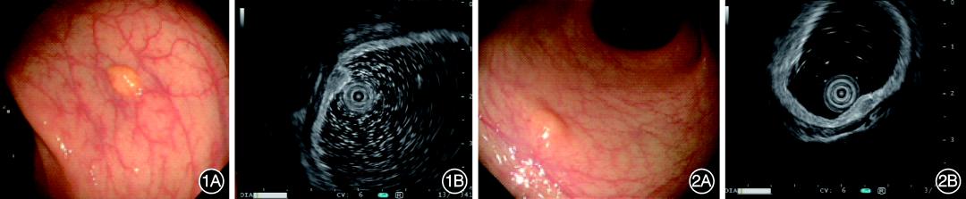 小探头超声内镜在不同起源层次直肠神经内分泌肿瘤诊断与治疗中的价值
