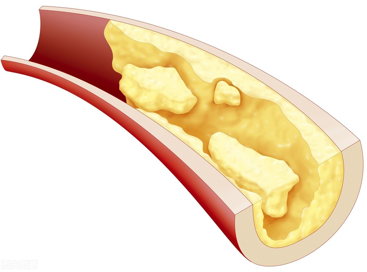 血脂异常的防治措施包括,血脂异常的治疗原则