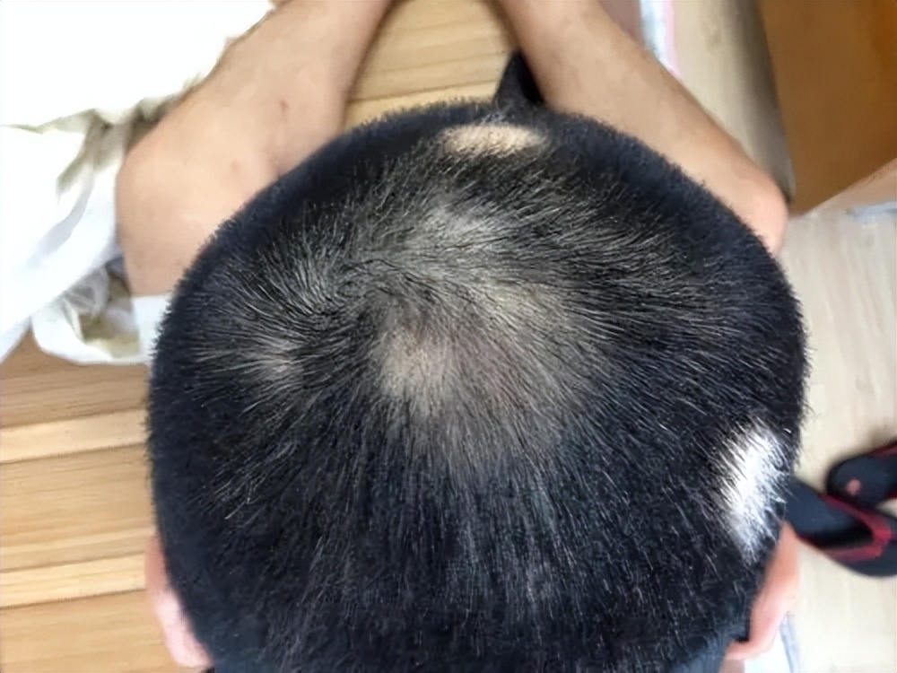 头部白癜风白发能治愈吗,头部白癜风治疗后反而扩散