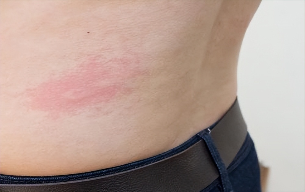 蛇盘疮越长越多怎么办,蛇盘疮腰缠一圈真的会要人命吗