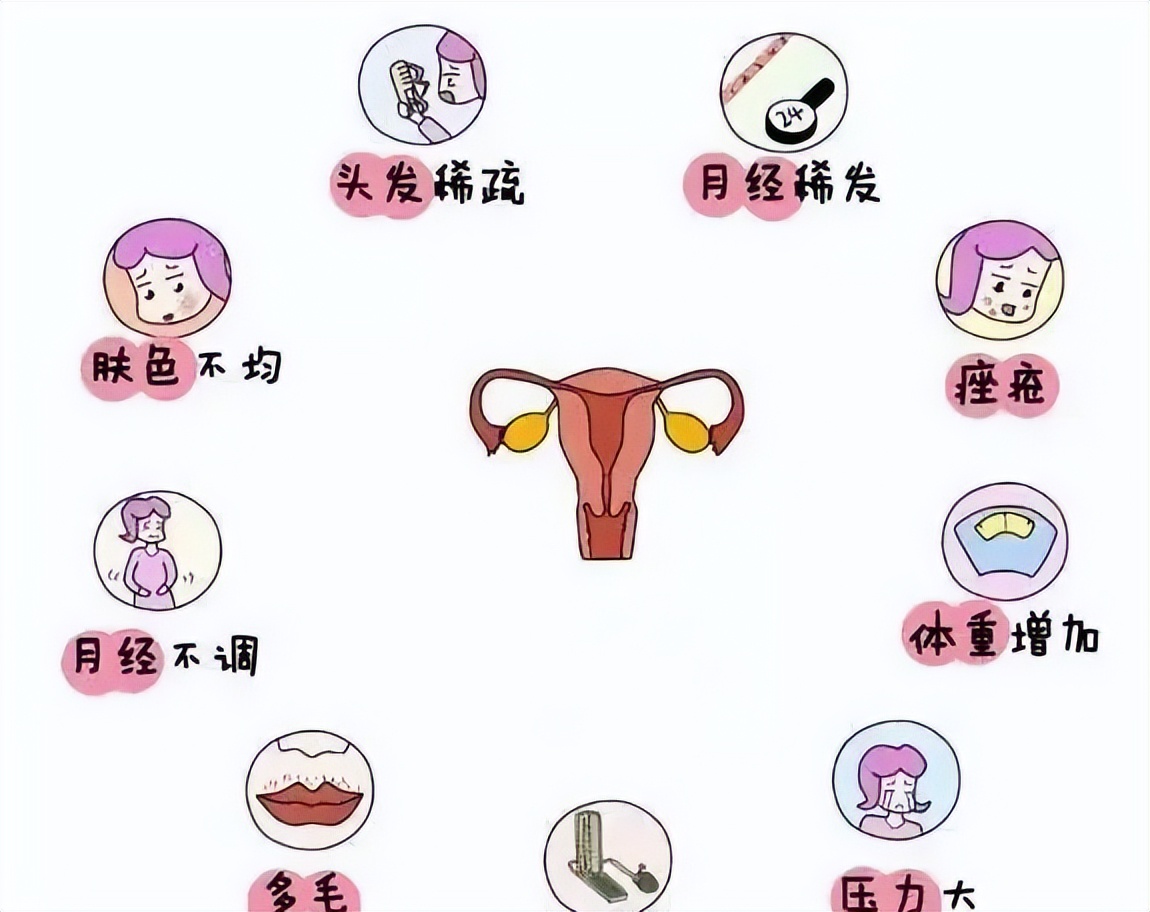 多囊卵巢发病率高吗,多囊卵巢综合征发病率是多少