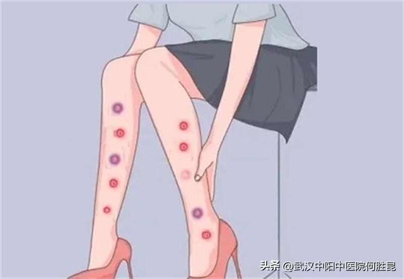 腿上长红色的小肉疙瘩怎么回事,腿上长红色大疙瘩痒是什么原因