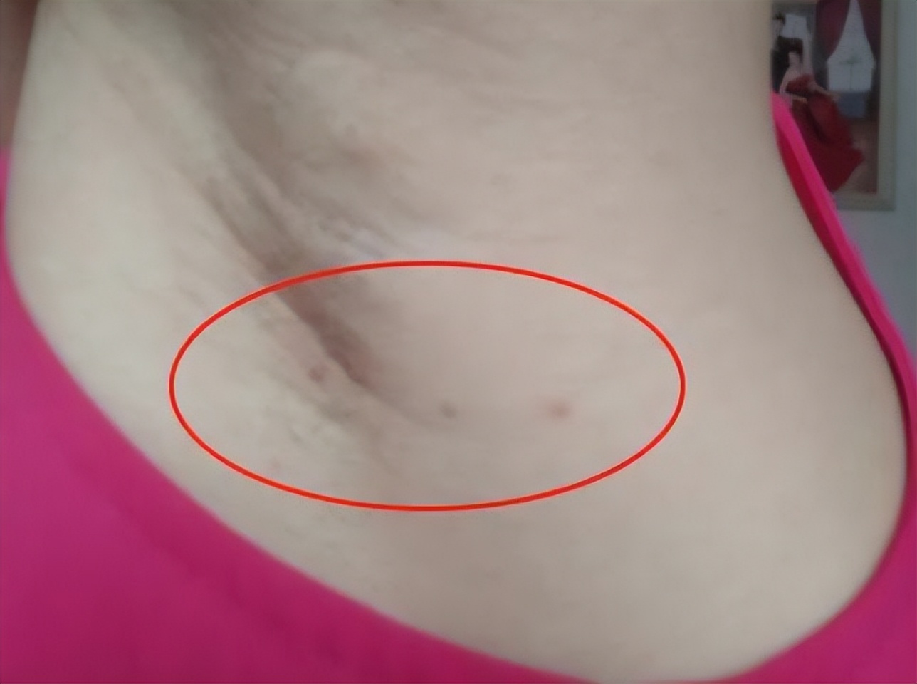 脖子上肉粒可以自己揪掉么,脖子腋下长小肉粒可以用手揪掉吗