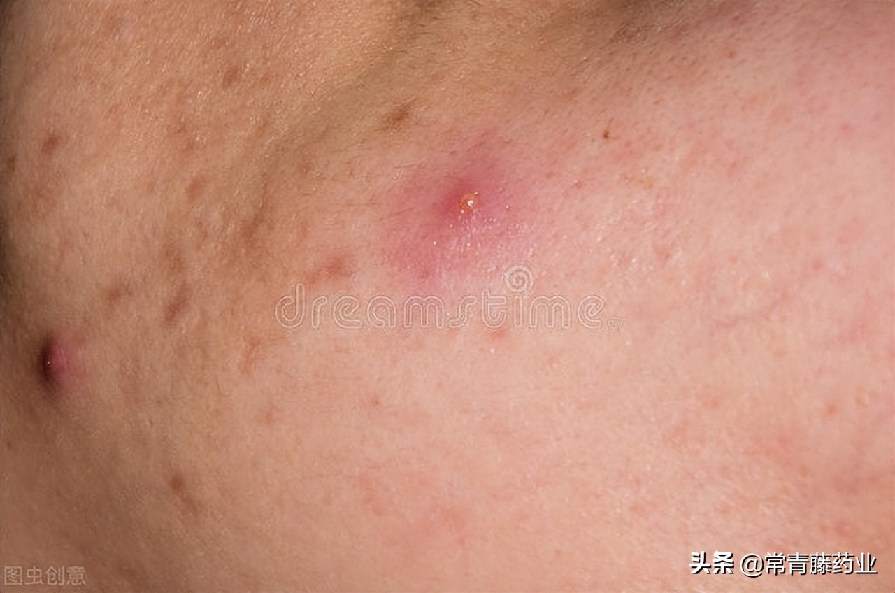 单纯疱疹和带状疱疹的区别是什么,带状疱疹是什么引起的呢