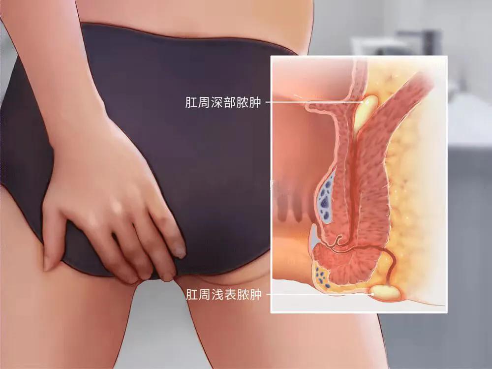 肛周脓肿自行溃破，也不疼了？是好了吗？