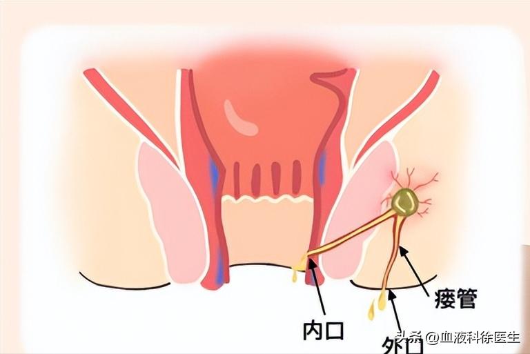 肛瘘手术真的有那么痛苦嘛,肛瘘手术在所有手术中的痛苦排名