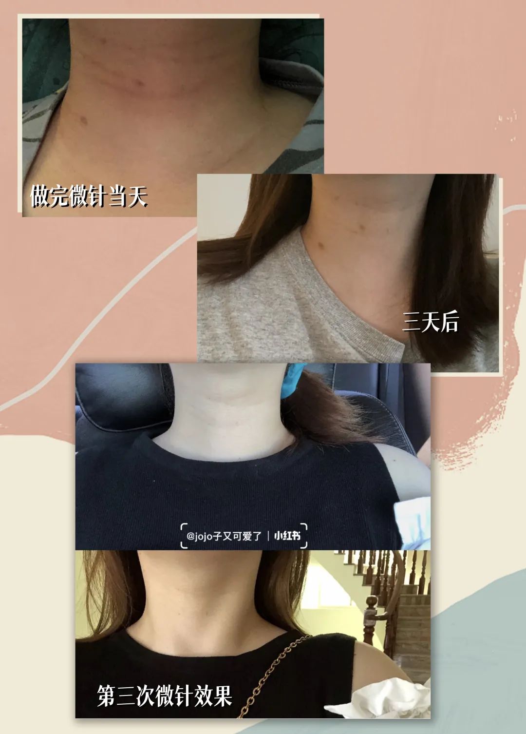 1条颈纹=显老10岁，可怕的颈纹还有救吗？