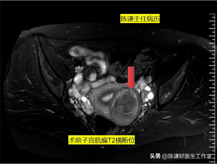 未婚未育子宫肌瘤该如何处理？