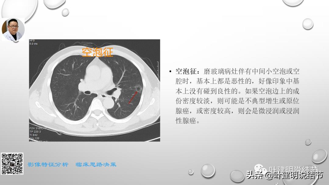 在《一脉阳光》呼吸影像诊断专题培训班上的讲课PPT（第一部分）