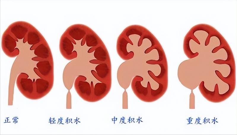 肾积水有多严重看完太可怕了,肾积水到底严不严重