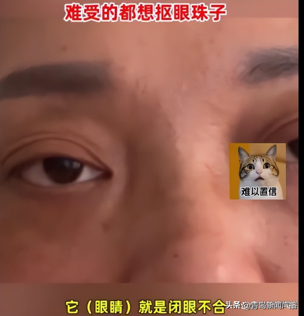 做眼袋毁容怎么活下去,女子花3000元割眼袋