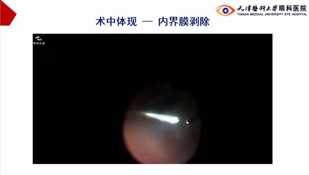 李筱荣教授,天津医科大学眼科医院李筱荣