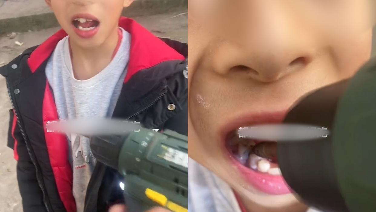 男孩蛀牙牙疼怎么办立刻止疼,男孩子蛀牙