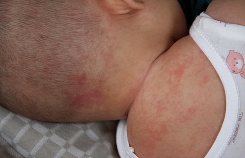 1岁宝宝发烧3天反复发烧正常吗,发烧退烧后出疹子怎么回事