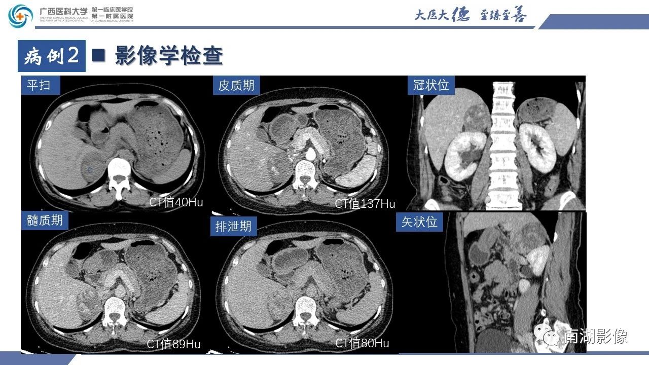 肾上腺海绵状血管瘤,肾上腺血管瘤是良性还是恶性