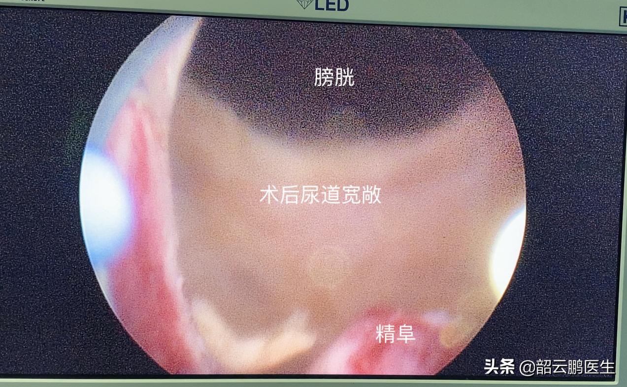 前列腺切除后需要终生戴尿不湿吗,做了前列腺漏尿最有效的恢复方法