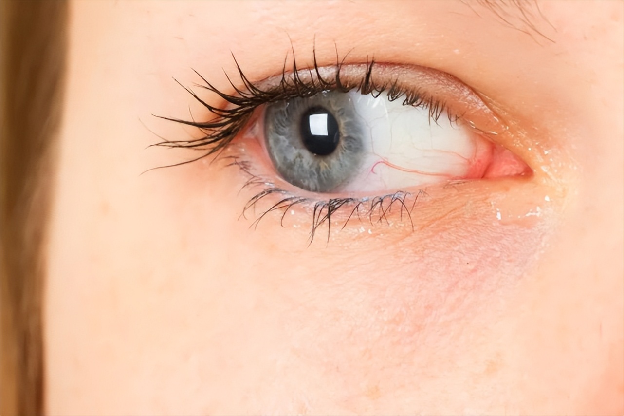 眼睛白眼球发黄中药怎么调理,眼睛干涩白眼球发黄是什么原因