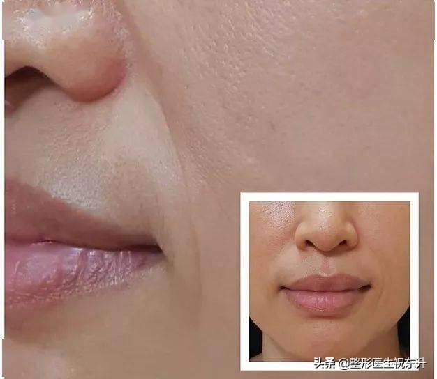 法令纹太深了怎么办？十有八九是这4种原因所致