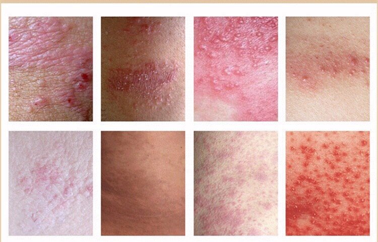 真菌清热除湿的口服中成药,细菌性皮肤病的常用药