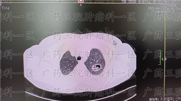 家里有人阳了，肺癌患者如何自处