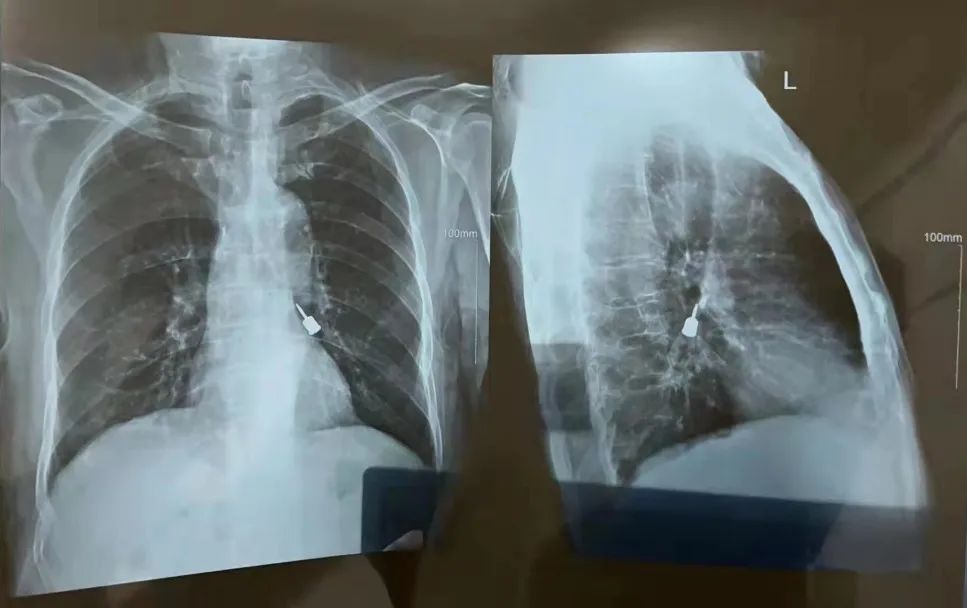 异物掉到支气管肺里怎么办,异物从气管掉入肺里咋办