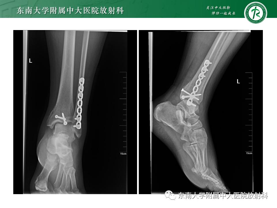 左腓骨下段骨折伴下胫腓联合分离,好文分享深度揭秘