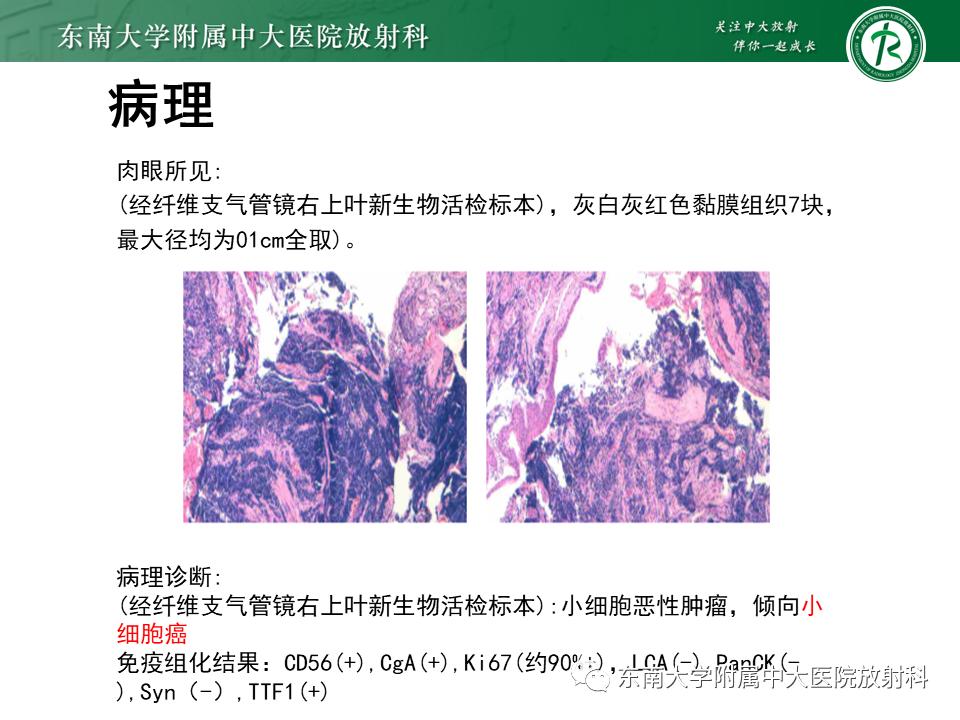 好文分享值得深思,纵隔精原细胞瘤